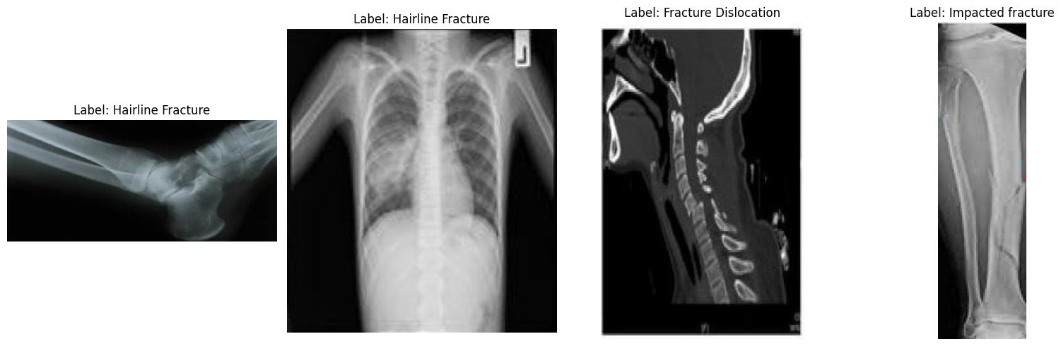 4 muestras aleatorias del conjunto de datos sobre fracturas óseas